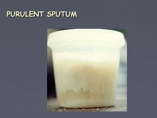 PURULENT SPUTUM
 