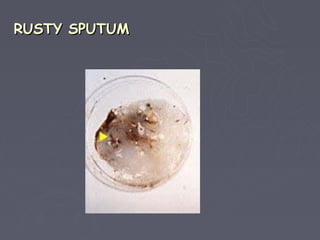 RUSTY SPUTUM
 
