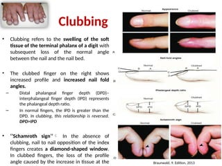 Nail Clubbing Algorithm History_Taking_and_Physical_Examination_of_Cardiovascular_System.pptx