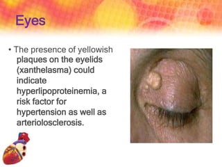 Eyes
• The presence of yellowish
plaques on the eyelids
(xanthelasma) could
indicate
hyperlipoproteinemia, a
risk factor for
hypertension as well as
arteriolosclerosis.
 