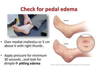 Check for pedal edema
• Over medial malleolus or 5 cm
above it with right thumb..
• Apply pressure for minimum
30 seconds…and look for
dimple pitting edema
 