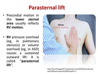 http://fourthstage2017.byethost16.com/[OSCE]/Cardiovasc
ular%20Examination%20HDD.pdf?i=1
Parasternal lift
• Precordial motion in
the lower sternal
area usually reflects
RV motion.
• RV pressure overload
(eg, in pulmonary
stenosis) or volume
overload (eg, in ASD)
causes a sustained
outward lift. It is
called ‘’parasternal
lift’’.
 