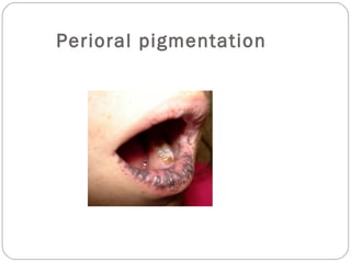 Perioral pigmentation
 