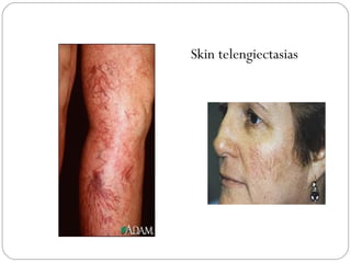 Skin telengiectasias
 
