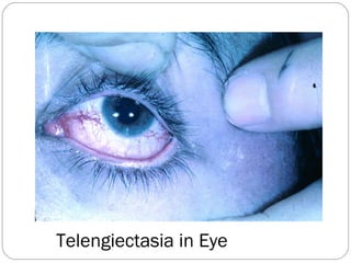 Telengiectasia in Eye
 