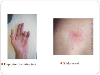 Dupuytren’s contracture   Spider naevi
 