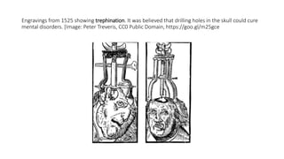 Engravings from 1525 showing trephination. It was believed that drilling holes in the skull could cure
mental disorders. [Image: Peter Treveris, CC0 Public Domain, https://goo.gl/m25gce
 