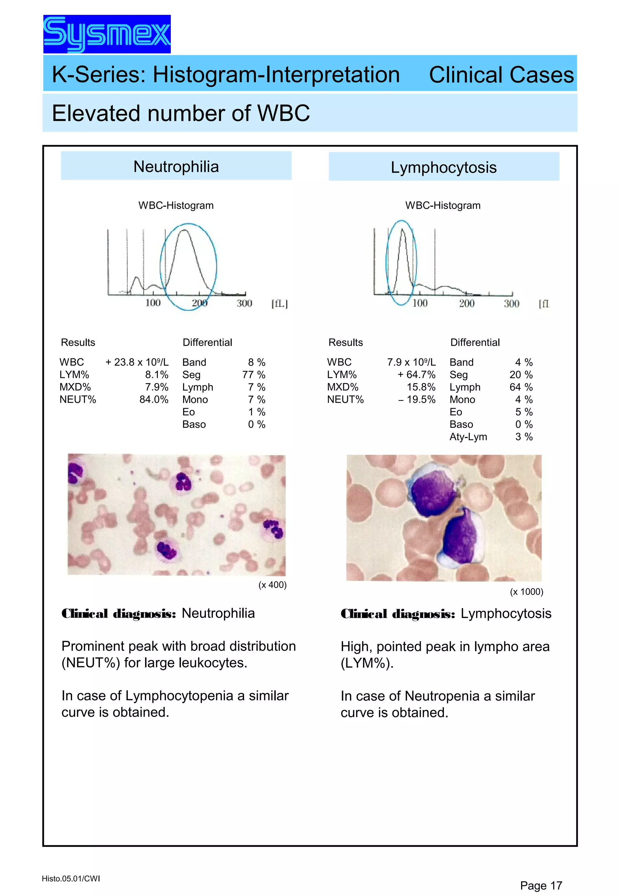 K-Series: Histogram-Interpretation
Histo.05.01/CWI
Page 17
Neutrophilia
Band
Seg
Lymph
Mono
Eo
Baso
8 %
77 %
7 %
7 %
1 %
0 %
Differential
WBC
LYM%
MXD%
NEUT%
Results
+ 23.8 x 109
/L
8.1%
7.9%
84.0%
Lymphocytosis
Band
Seg
Lymph
Mono
Eo
Baso
Aty-Lym
4 %
20 %
64 %
4 %
5 %
0 %
3 %
Differential
WBC
LYM%
MXD%
NEUT%
Results
7.9 x 109
/L
+ 64.7%
15.8%
– 19.5%
(x 400)
(x 1000)
Elevated number of WBC
WBC-Histogram WBC-Histogram
Clinical Cases
Clinical diagnosis: Neutrophilia
Prominent peak with broad distribution
(NEUT%) for large leukocytes.
In case of Lymphocytopenia a similar
curve is obtained.
Clinical diagnosis: Lymphocytosis
High, pointed peak in lympho area
(LYM%).
In case of Neutropenia a similar
curve is obtained.
 