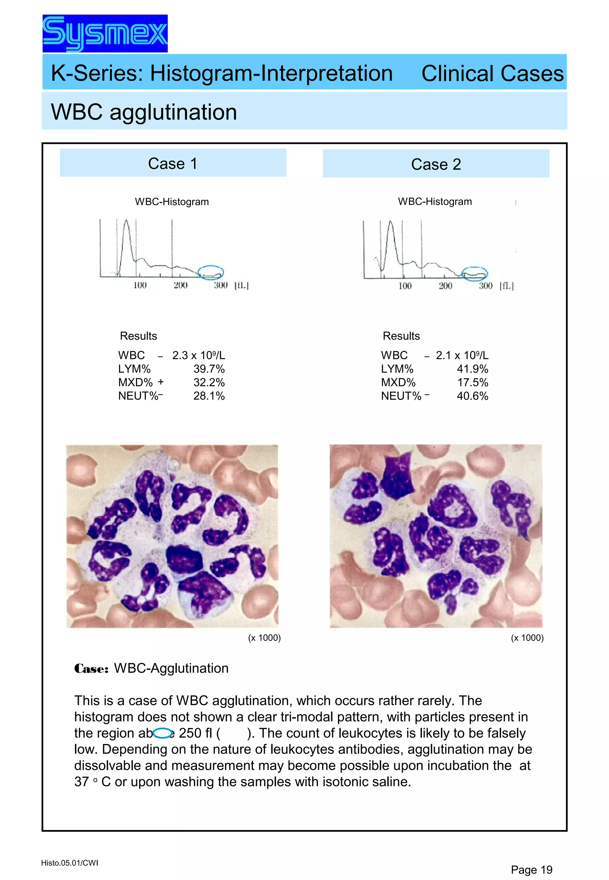 K-Series: Histogram-Interpretation
Histo.05.01/CWI
Page 19
Case 1 Case 2
WBC agglutination
(x 1000) (x 1000)
WBC-Histogram WBC-Histogram
Clinical Cases
WBC
LYM%
MXD%
NEUT%
Results
2.3 x 109
/L
39.7%
32.2%
28.1%
–
+
–
WBC
LYM%
MXD%
NEUT%
Results
2.1 x 109
/L
41.9%
17.5%
40.6%
–
–
Case: WBC-Agglutination
This is a case of WBC agglutination, which occurs rather rarely. The
histogram does not shown a clear tri-modal pattern, with particles present in
the region above 250 fl ( ). The count of leukocytes is likely to be falsely
low. Depending on the nature of leukocytes antibodies, agglutination may be
dissolvable and measurement may become possible upon incubation the at
37 o
C or upon washing the samples with isotonic saline.
 