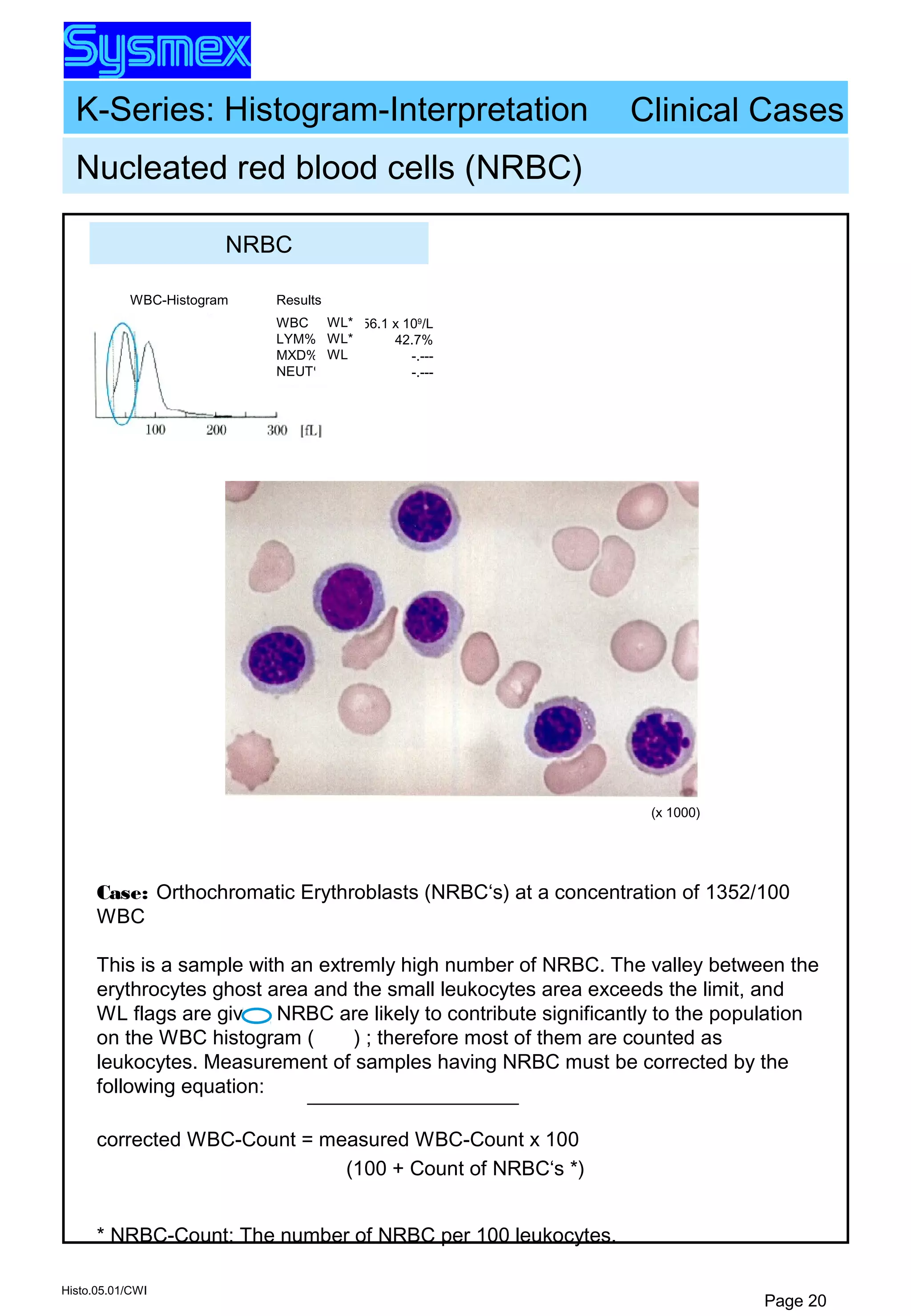 K-Series: Histogram-Interpretation
Histo.05.01/CWI
Page 20
Nucleated red blood cells (NRBC)
(x 1000)
WBC
LYM%
MXD%
NEUT%
Results
56.1 x 109
/L
42.7%
-.---
-.---
WBC-Histogram
WL*
WL*
WL
Clinical Cases
Case: Orthochromatic Erythroblasts (NRBC‘s) at a concentration of 1352/100
WBC
This is a sample with an extremly high number of NRBC. The valley between the
erythrocytes ghost area and the small leukocytes area exceeds the limit, and
WL flags are given. NRBC are likely to contribute significantly to the population
on the WBC histogram ( ) ; therefore most of them are counted as
leukocytes. Measurement of samples having NRBC must be corrected by the
following equation:
corrected WBC-Count = measured WBC-Count x 100
(100 + Count of NRBC‘s *)
* NRBC-Count: The number of NRBC per 100 leukocytes.
NRBC
 