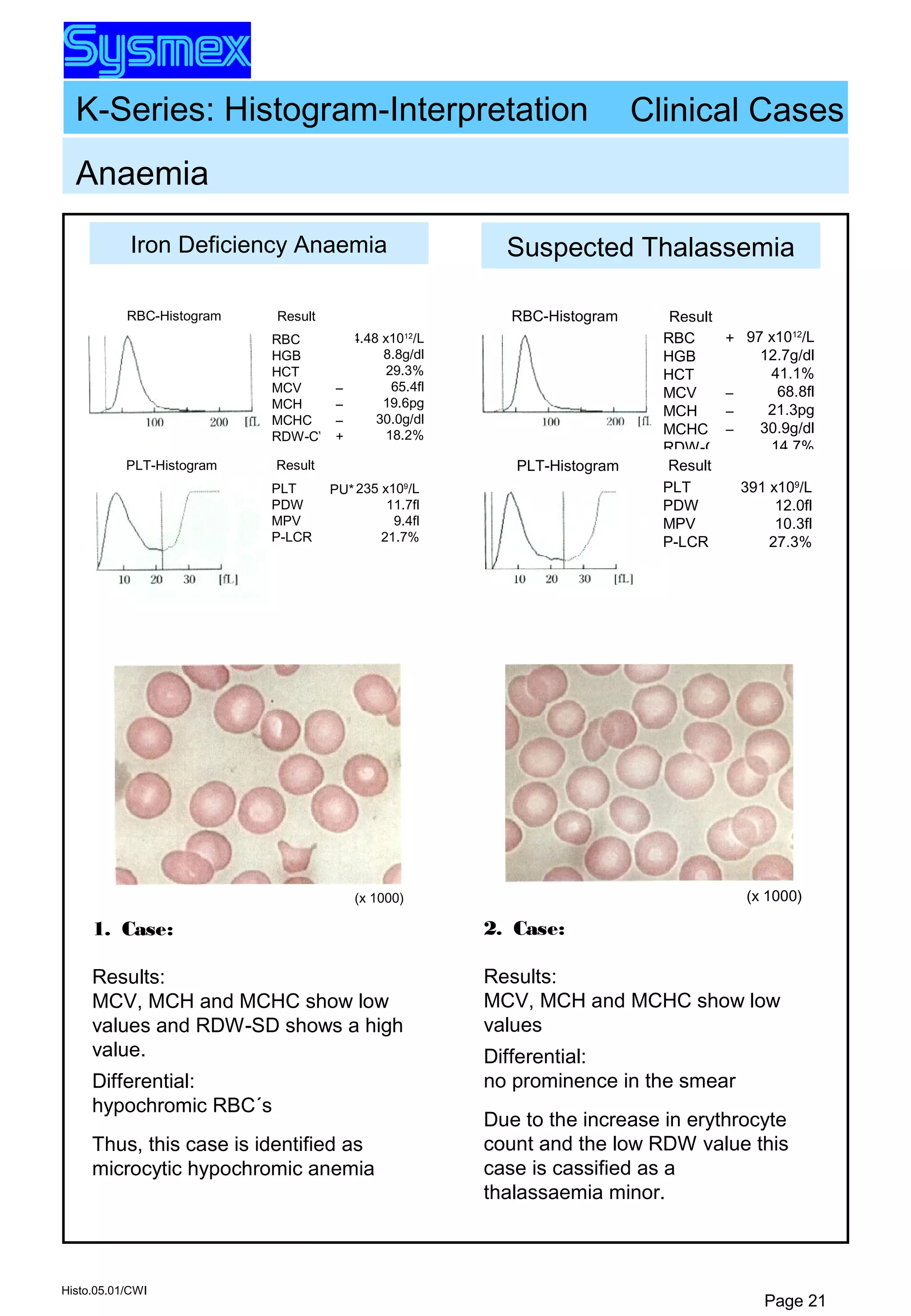 K-Series: Histogram-Interpretation
Histo.05.01/CWI
Page 21
Iron Deficiency Anaemia
Anaemia
RBC-Histogram Result
RBC
HGB
HCT
MCV
MCH
MCHC
RDW-CV
4.48 x1012
/L
8.8g/dl
29.3%
65.4fl
19.6pg
30.0g/dl
18.2%
–
–
–
+
Result
PLT
PDW
MPV
P-LCR
235 x109
/L
11.7fl
9.4fl
21.7%
PLT-Histogram
(x 1000)
Clinical Cases
1. Case:
Results:
MCV, MCH and MCHC show low
values and RDW-SD shows a high
value.
Differential:
hypochromic RBC´s
Thus, this case is identified as
microcytic hypochromic anemia
Suspected Thalassemia
Result
RBC
HGB
HCT
MCV
MCH
MCHC
RDW-CV
5.97 x1012
/L
12.7g/dl
41.1%
68.8fl
21.3pg
30.9g/dl
14.7%
+
–
–
–
RBC-Histogram
Result
PLT
PDW
MPV
P-LCR
391 x109
/L
12.0fl
10.3fl
27.3%
PLT-Histogram
(x 1000)
2. Case:
Results:
MCV, MCH and MCHC show low
values
Differential:
no prominence in the smear
Due to the increase in erythrocyte
count and the low RDW value this
case is cassified as a
thalassaemia minor.
PU*
 