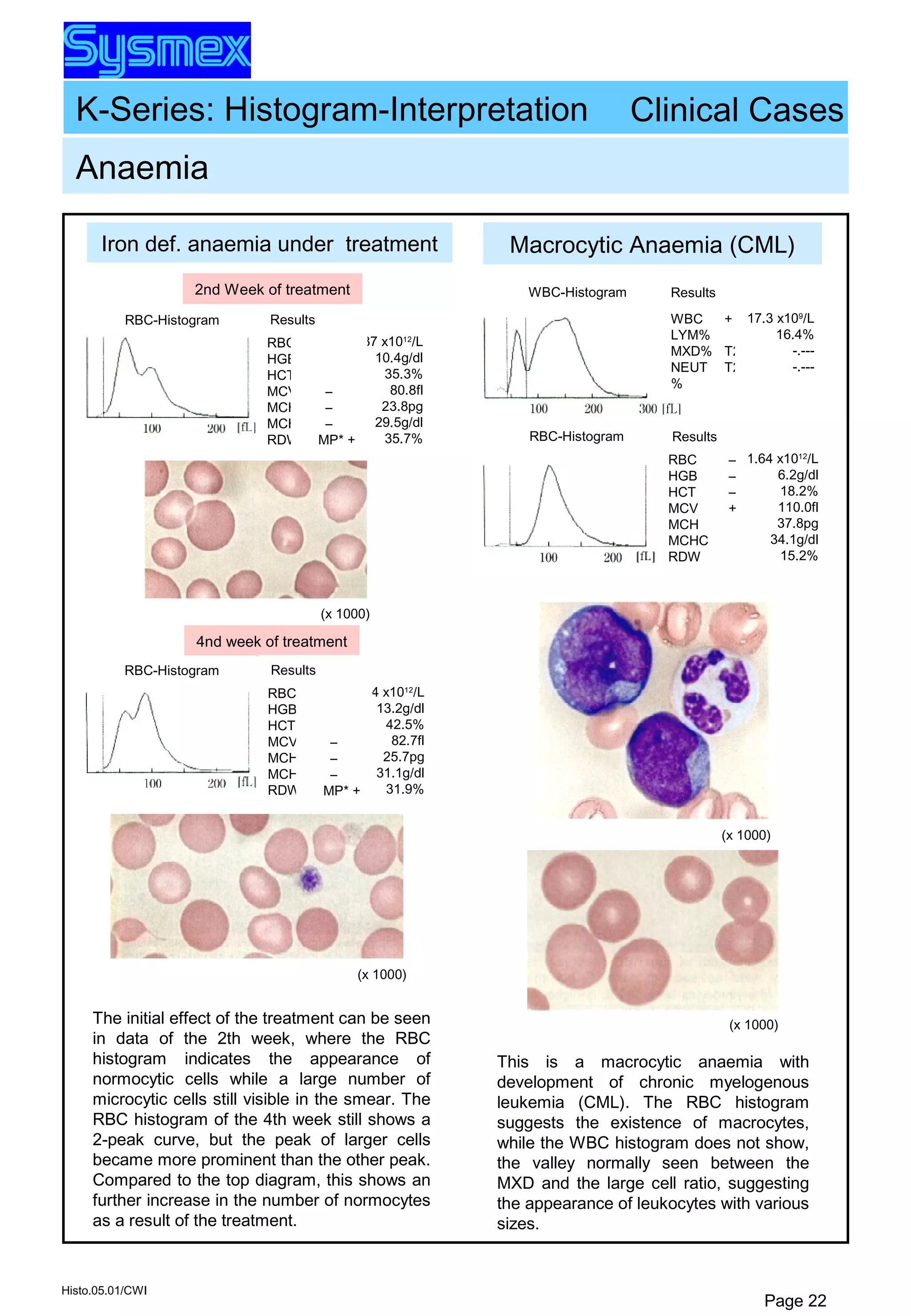 K-Series: Histogram-Interpretation
Histo.05.01/CWI
Page 22
Anaemia
Clinical Cases
Macrocytic Anaemia (CML)
(x 1000)
(x 1000)
Results
RBC
HGB
HCT
MCV
MCH
MCHC
RDW
1.64 x1012
/L
6.2g/dl
18.2%
110.0fl
37.8pg
34.1g/dl
15.2%
–
–
–
+
RBC-Histogram
WBC-Histogram Results
WBC
LYM%
MXD%
NEUT
%
+
T2
T2
17.3 x109
/L
16.4%
-.---
-.---
This is a macrocytic anaemia with
development of chronic myelogenous
leukemia (CML). The RBC histogram
suggests the existence of macrocytes,
while the WBC histogram does not show,
the valley normally seen between the
MXD and the large cell ratio, suggesting
the appearance of leukocytes with various
sizes.
Iron def. anaemia under treatment
2nd Week of treatment
RBC-Histogram Results
RBC
HGB
HCT
MCV
MCH
MCHC
RDW
4.37 x1012
/L
10.4g/dl
35.3%
80.8fl
23.8pg
29.5g/dl
35.7%
–
–
–
MP* +
4nd week of treatment
RBC-Histogram Results
RBC
HGB
HCT
MCV
MCH
MCHC
RDW
5.14 x1012
/L
13.2g/dl
42.5%
82.7fl
25.7pg
31.1g/dl
31.9%
(x 1000)
(x 1000)
The initial effect of the treatment can be seen
in data of the 2th week, where the RBC
histogram indicates the appearance of
normocytic cells while a large number of
microcytic cells still visible in the smear. The
RBC histogram of the 4th week still shows a
2-peak curve, but the peak of larger cells
became more prominent than the other peak.
Compared to the top diagram, this shows an
further increase in the number of normocytes
as a result of the treatment.
–
–
–
MP* +
 