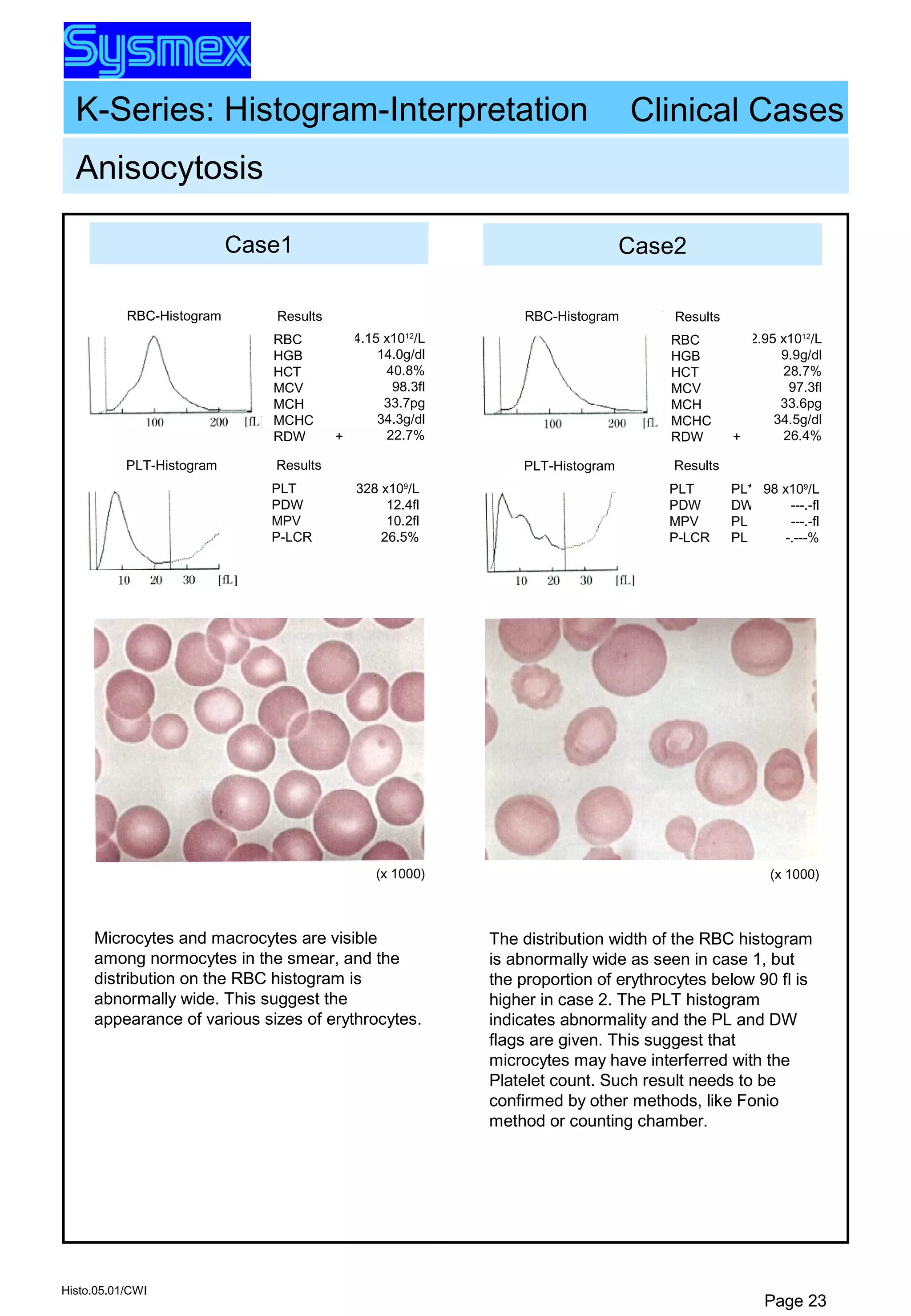 K-Series: Histogram-Interpretation
Histo.05.01/CWI
Page 23
Case1 Case2
Anisocytosis
RBC-Histogram Results
RBC
HGB
HCT
MCV
MCH
MCHC
RDW
4.15 x1012
/L
14.0g/dl
40.8%
98.3fl
33.7pg
34.3g/dl
22.7%+
Results
PLT
PDW
MPV
P-LCR
328 x109
/L
12.4fl
10.2fl
26.5%
PLT-Histogram
(x 1000)
RBC-Histogram Results
RBC
HGB
HCT
MCV
MCH
MCHC
RDW
2.95 x1012
/L
9.9g/dl
28.7%
97.3fl
33.6pg
34.5g/dl
26.4%+
Results
PLT
PDW
MPV
P-LCR
PL*
DW
PL
PL
98 x109
/L
---.-fl
---.-fl
-.---%
PLT-Histogram
(x 1000)
Clinical Cases
Microcytes and macrocytes are visible
among normocytes in the smear, and the
distribution on the RBC histogram is
abnormally wide. This suggest the
appearance of various sizes of erythrocytes.
The distribution width of the RBC histogram
is abnormally wide as seen in case 1, but
the proportion of erythrocytes below 90 fl is
higher in case 2. The PLT histogram
indicates abnormality and the PL and DW
flags are given. This suggest that
microcytes may have interferred with the
Platelet count. Such result needs to be
confirmed by other methods, like Fonio
method or counting chamber.
 
