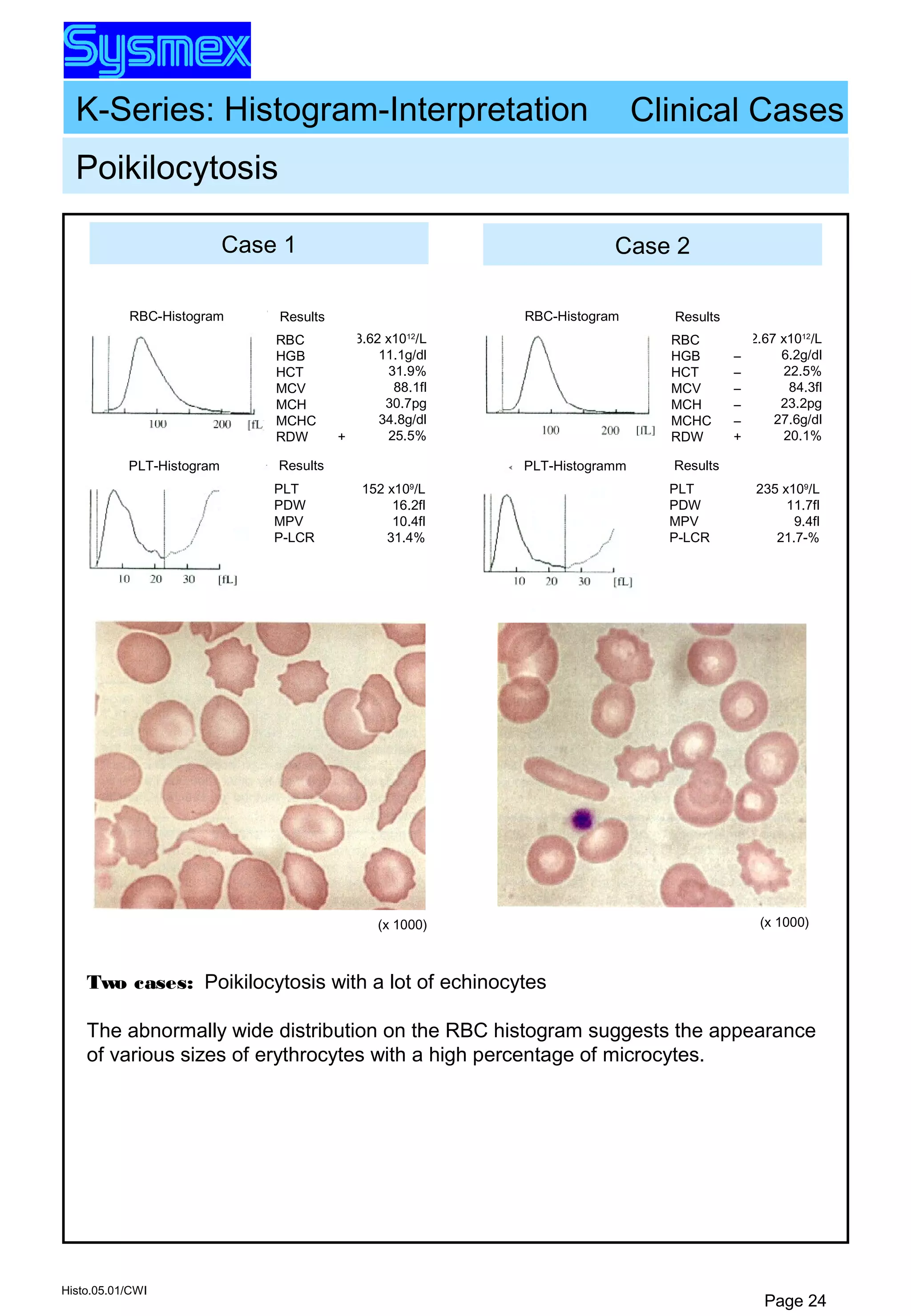 K-Series: Histogram-Interpretation
Histo.05.01/CWI
Page 24
Case 1 Case 2
Poikilocytosis
RBC-Histogram Results
RBC
HGB
HCT
MCV
MCH
MCHC
RDW
3.62 x1012
/L
11.1g/dl
31.9%
88.1fl
30.7pg
34.8g/dl
25.5%+
Results
PLT
PDW
MPV
P-LCR
152 x109
/L
16.2fl
10.4fl
31.4%
PLT-Histogram
(x 1000)
RBC-Histogram Results
RBC
HGB
HCT
MCV
MCH
MCHC
RDW
2.67 x1012
/L
6.2g/dl
22.5%
84.3fl
23.2pg
27.6g/dl
20.1%
–
–
–
–
–
+
Results
PLT
PDW
MPV
P-LCR
235 x109
/L
11.7fl
9.4fl
21.7-%
PLT-Histogramm
(x 1000)
Clinical Cases
Two cases: Poikilocytosis with a lot of echinocytes
The abnormally wide distribution on the RBC histogram suggests the appearance
of various sizes of erythrocytes with a high percentage of microcytes.
 