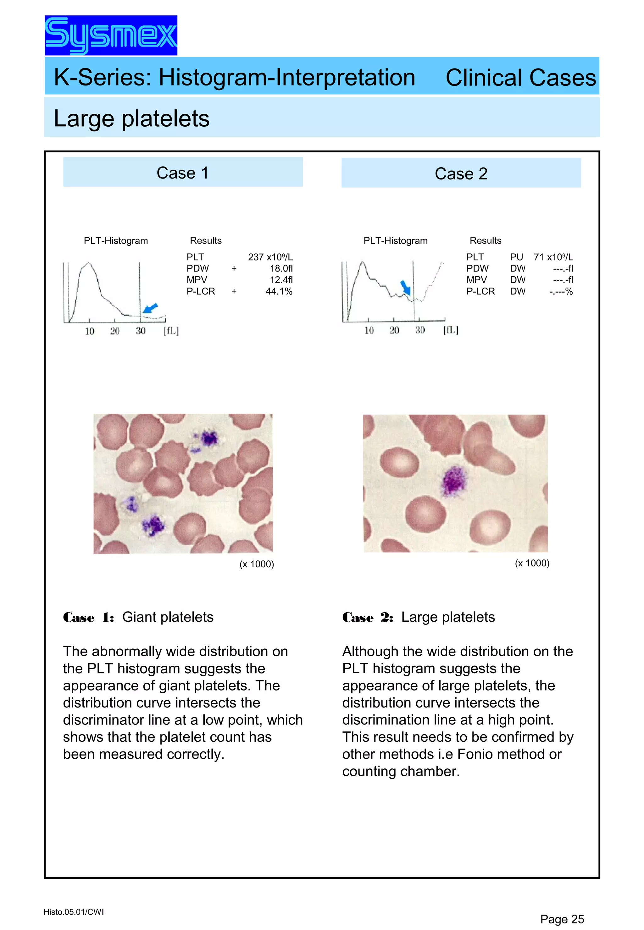 K-Series: Histogram-Interpretation
Histo.05.01/CWI
Page 25
Case 1 Case 2
Large platelets
Results
PLT
PDW
MPV
P-LCR
+
+
237 x109
/L
18.0fl
12.4fl
44.1%
PLT-Histogram
(x 1000)
Results
PLT
PDW
MPV
P-LCR
PU
DW
DW
DW
71 x109
/L
---.-fl
---.-fl
-.---%
PLT-Histogram
(x 1000)
Clinical Cases
Case 1: Giant platelets
The abnormally wide distribution on
the PLT histogram suggests the
appearance of giant platelets. The
distribution curve intersects the
discriminator line at a low point, which
shows that the platelet count has
been measured correctly.
Case 2: Large platelets
Although the wide distribution on the
PLT histogram suggests the
appearance of large platelets, the
distribution curve intersects the
discrimination line at a high point.
This result needs to be confirmed by
other methods i.e Fonio method or
counting chamber.
 
