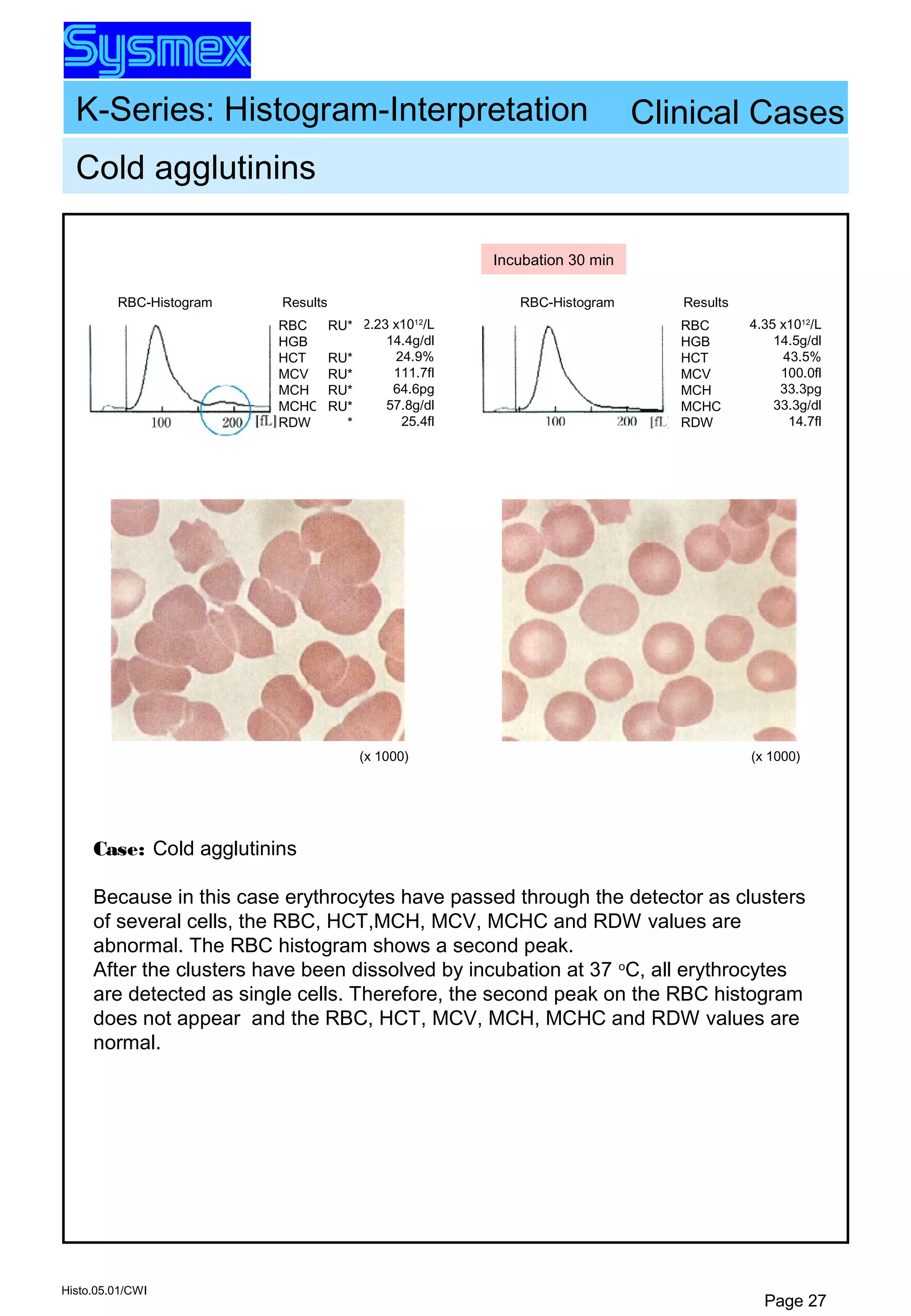 K-Series: Histogram-Interpretation
Histo.05.01/CWI
Page 27
Cold agglutinins
RBC-Histogram Results
RBC
HGB
HCT
MCV
MCH
MCHC
RDW
2.23 x1012
/L
14.4g/dl
24.9%
111.7fl
64.6pg
57.8g/dl
25.4fl
RU*
RU*
RU*
RU*
RU*
*
(x 1000)
ResultsRBC-Histogram
RBC
HGB
HCT
MCV
MCH
MCHC
RDW
4.35 x1012
/L
14.5g/dl
43.5%
100.0fl
33.3pg
33.3g/dl
14.7fl
Incubation 30 min
(x 1000)
Case: Cold agglutinins
Because in this case erythrocytes have passed through the detector as clusters
of several cells, the RBC, HCT,MCH, MCV, MCHC and RDW values are
abnormal. The RBC histogram shows a second peak.
After the clusters have been dissolved by incubation at 37 o
C, all erythrocytes
are detected as single cells. Therefore, the second peak on the RBC histogram
does not appear and the RBC, HCT, MCV, MCH, MCHC and RDW values are
normal.
Clinical Cases
 