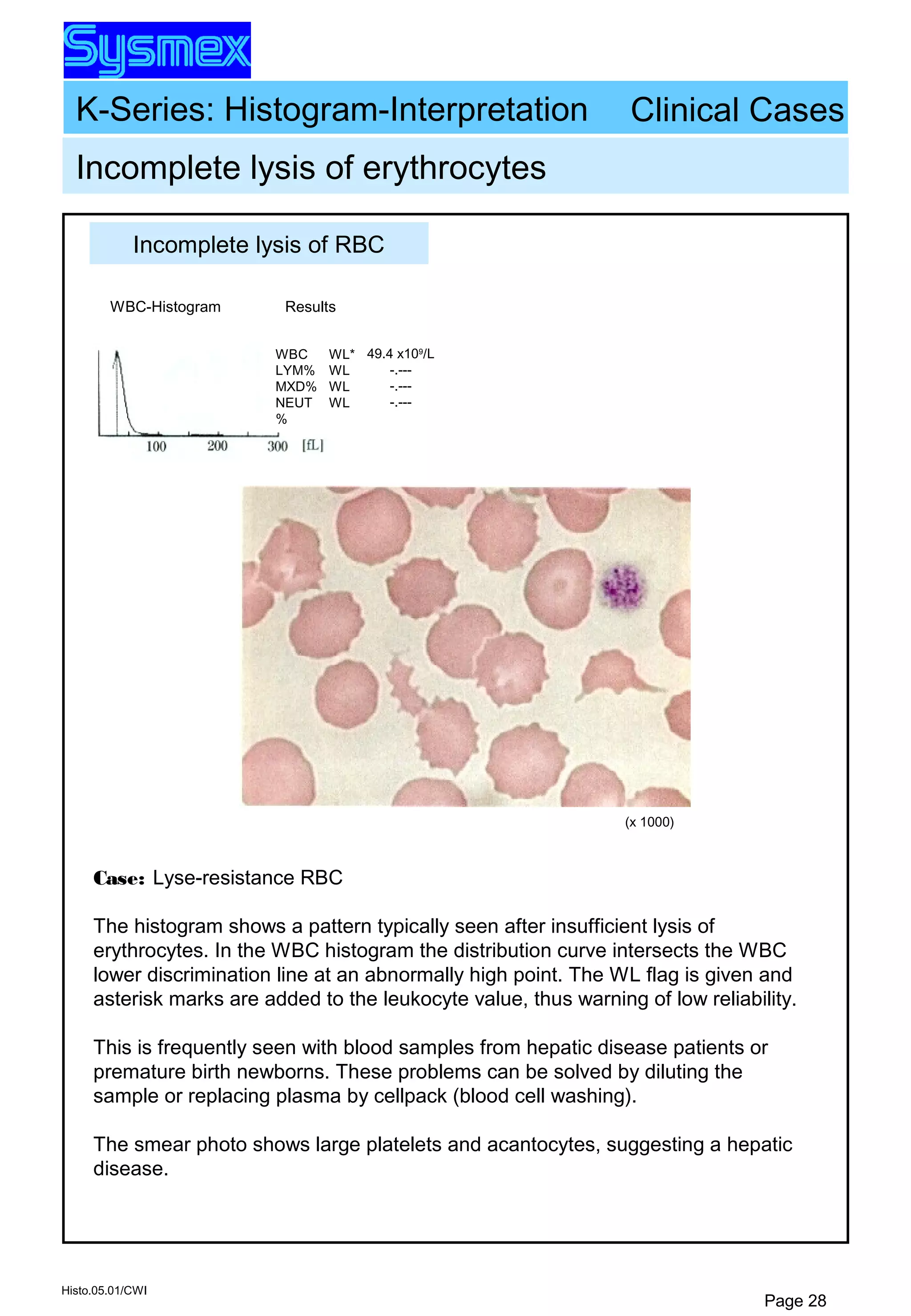 K-Series: Histogram-Interpretation
Histo.05.01/CWI
Page 28
(x 1000)
Incomplete lysis of erythrocytes
Clinical Cases
WBC
LYM%
MXD%
NEUT
%
WL*
WL
WL
WL
49.4 x109
/L
-.---
-.---
-.---
WBC-Histogram Results
Case: Lyse-resistance RBC
The histogram shows a pattern typically seen after insufficient lysis of
erythrocytes. In the WBC histogram the distribution curve intersects the WBC
lower discrimination line at an abnormally high point. The WL flag is given and
asterisk marks are added to the leukocyte value, thus warning of low reliability.
This is frequently seen with blood samples from hepatic disease patients or
premature birth newborns. These problems can be solved by diluting the
sample or replacing plasma by cellpack (blood cell washing).
The smear photo shows large platelets and acantocytes, suggesting a hepatic
disease.
Incomplete lysis of RBC
 