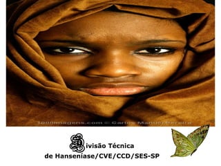 São Paulo/2008
                                      C   réditos:
                                 Heleida Nobrega Metello




                 D   ivisão Técnica
        de Hanseníase/CVE/CCD/SES-SP
 