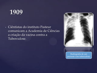1909
•

Ciêntistas do instituto Pasteur
comunicam a Academia de Ciências
a criação da vacina contra a
Tuberculose.

Radiografia de um
paciente com tuberculose.

 