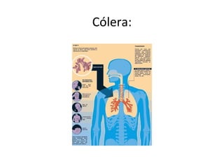 Cólera:
 