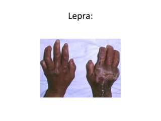 Lepra:
 