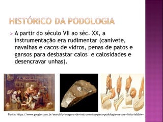  A partir do século VII ao séc. XX, a
instrumentação era rudimentar (canivete,
navalhas e cacos de vidros, penas de patos e
gansos para desbastar calos e calosidades e
desencravar unhas).
Fonte: https://www.google.com.br/search?q=imagens+de+instrumentos+para+podologia+na+pre+historia&biw=
 