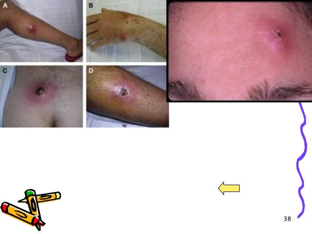 hidradenitis suppurativa clinic near me