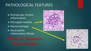 PATHOLOGICAL FEATURES
 Perivascular chronic
inflammation
 Microglial nodules
 Neuronophagia
 Neutrophilic
inflammatory filtrate
Bilateral Thalamic
Hemorrhage
 
