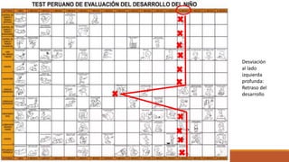 Desviación
al lado
izquierda
profunda:
Retraso del
desarrollo
 