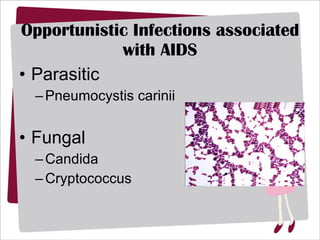 Opportunistic Infections associated with AIDS Parasitic Pneumocystis carinii Fungal Candida Cryptococcus 