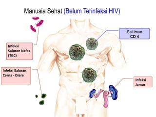 Manusia Sehat (Belum Terinfeksi HIV)

                                                    Sel Imun
                                                     CD 4

   Infeksi
   Saluran Nafas
   (TBC)


Infeksi Saluran
Cerna - Diare
                                                        Infeksi
                                                        Jamur
 