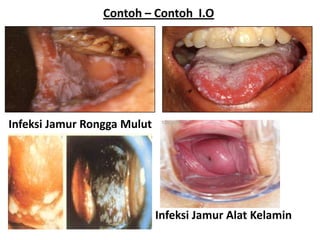 Contoh – Contoh I.O




Infeksi Jamur Rongga Mulut




                             Infeksi Jamur Alat Kelamin
 