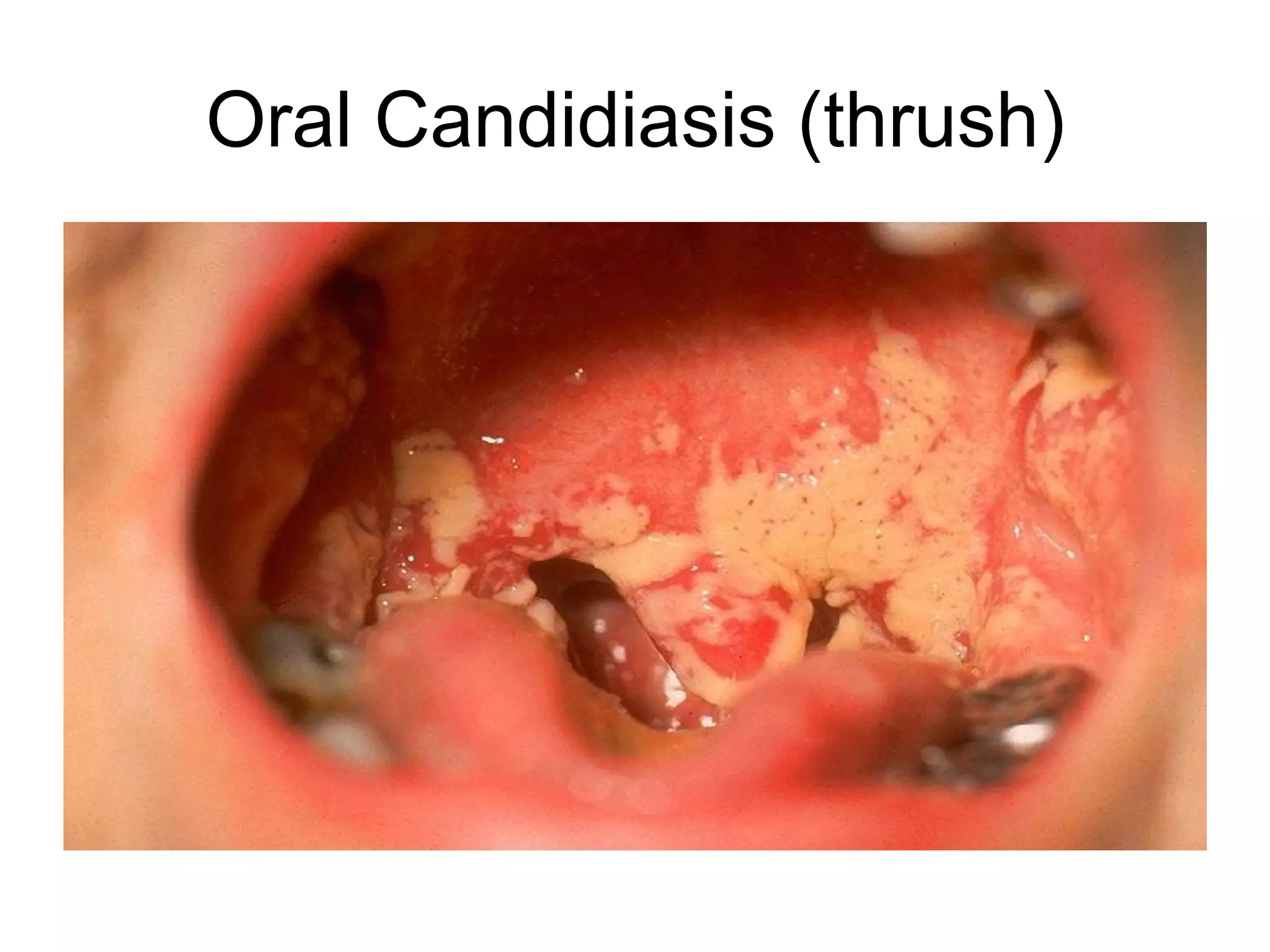Oral Candidiasis (thrush)
 
