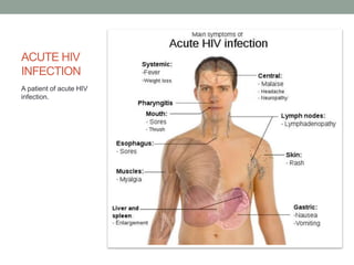 ACUTE HIV
INFECTION
A patient of acute HIV
infection.
 