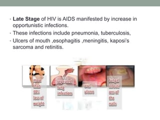 • Late Stage of HIV is AIDS manifested by increase in
opportunistic infections.
• These infections include pneumonia, tuberculosis,
• Ulcers of mouth ,esophagitis ,meningitis, kaposi’s
sarcoma and retinitis.
 