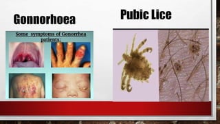 Gonnorhoea Pubic Lice
 