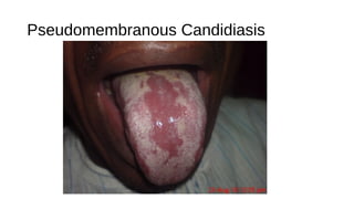 Pseudomembranous Candidiasis
 