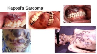 Kaposi’s Sarcoma
 