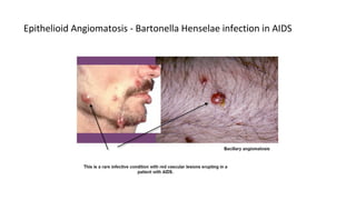 Epithelioid Angiomatosis - Bartonella Henselae infection in AIDS
 