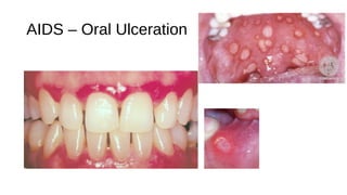 AIDS – Oral Ulceration
 