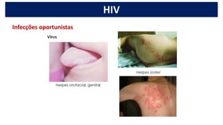HIV
Infecções oportunistas
 