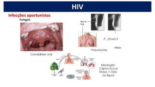 HIV
Infecções oportunistas
 