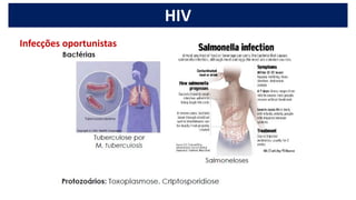 HIV
Infecções oportunistas
 