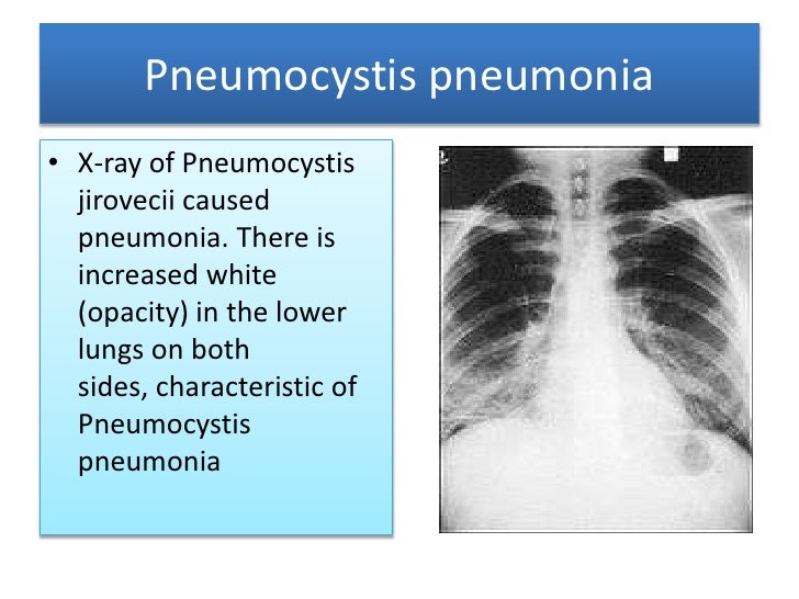 an analysis of acquired immune deficiency syndrome Acquired immune deficiency syndrome (aids) acquire immune deficiency syndrome, or aids, is a recently recognized disease it is caused by infection with the human immunodeficiency virus, or. an analysis of acquired immune deficiency syndrome Acquired immune deficiency syndrome (aids) acquire immune deficiency syndrome, or aids, is a recently recognized disease it is caused by infection with the human immunodeficiency virus, or.