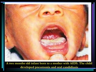 A two months old infant born to a mother with AIDS. The child
developed pneumonia and oral candidiasis
 