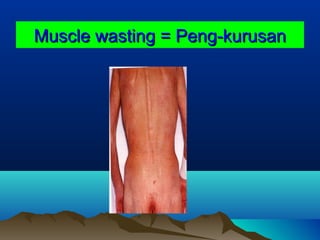 Muscle wasting = Peng-kurusanMuscle wasting = Peng-kurusan
 