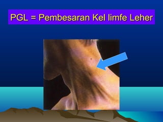 PGL = Pembesaran Kel limfe LeherPGL = Pembesaran Kel limfe Leher
 