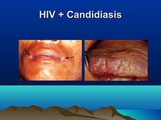 HIV + CandidiasisHIV + Candidiasis
 