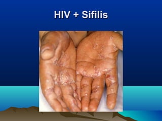 HIV + SifilisHIV + Sifilis
 