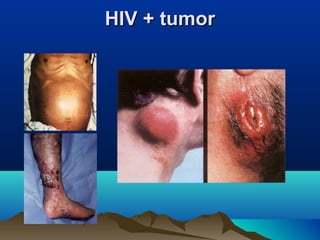 HIV + tumorHIV + tumor
 